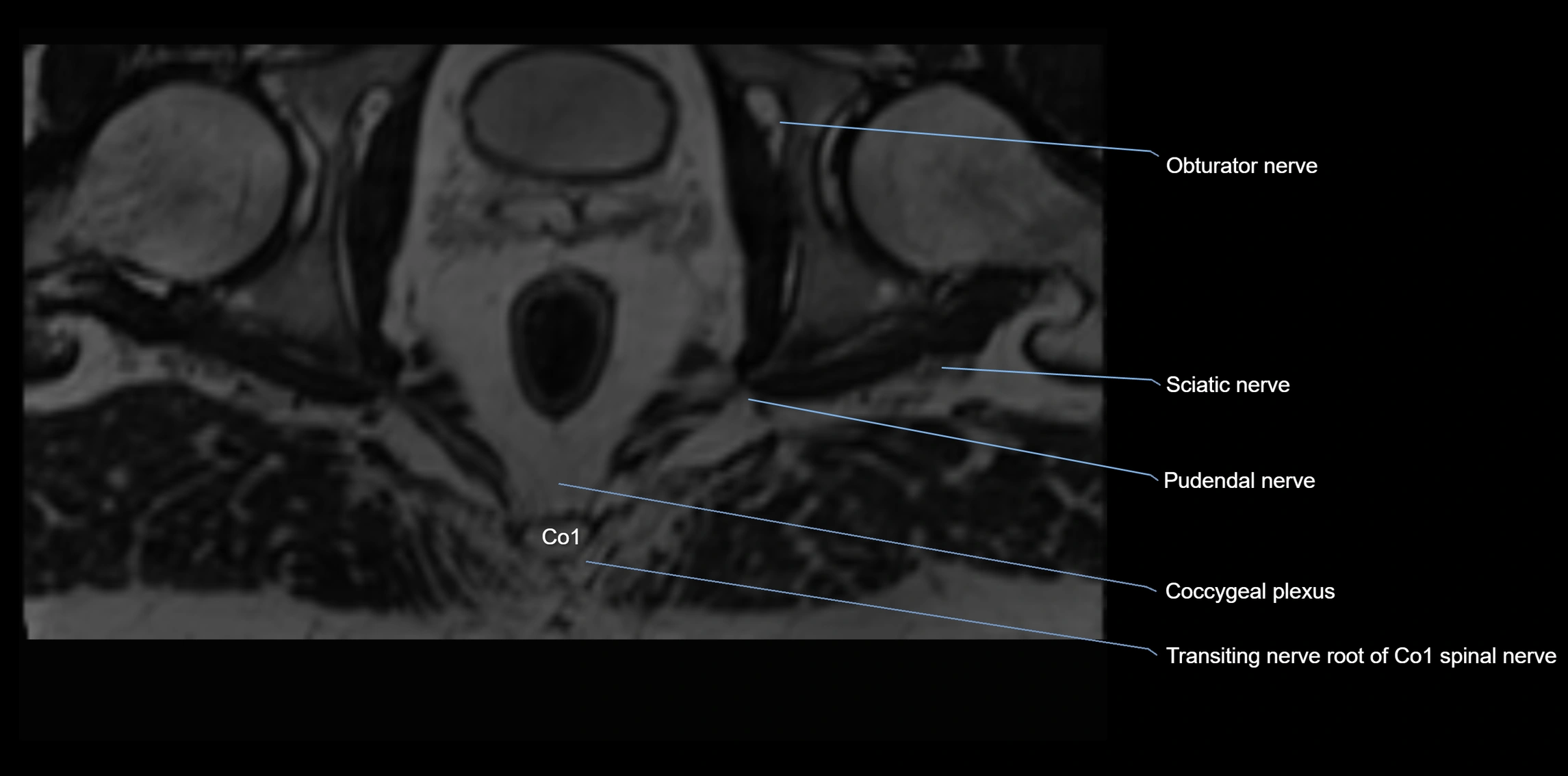 MR lumbosacral plexus axial cross sectional anatomy 3T  radiology  image-img-1008001-00127.webp